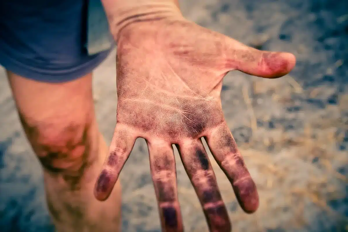 Fine-tipped tweezers being used to carefully remove an attached tick from skin